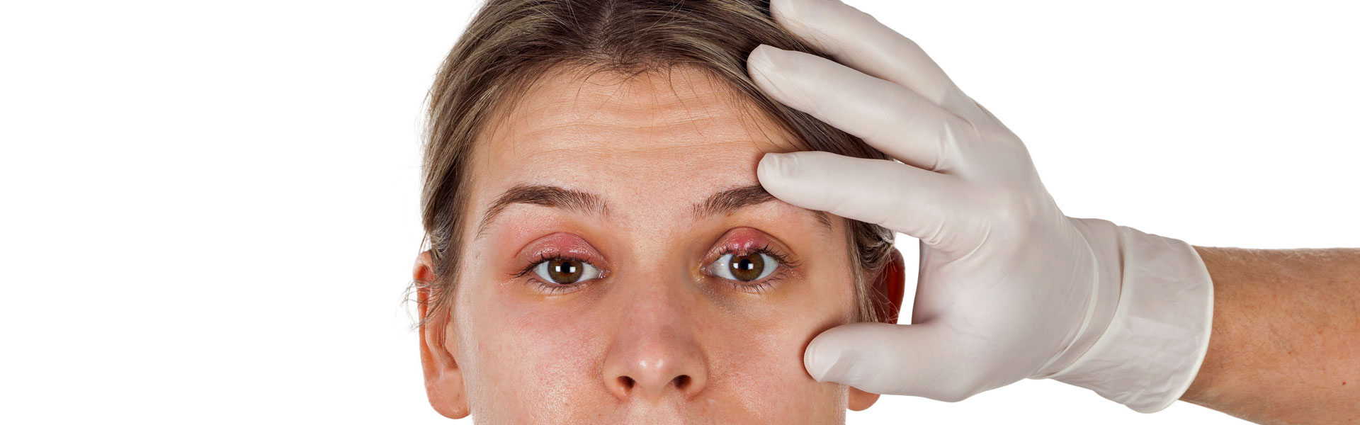 What You Need to Know About Blepharoplasty